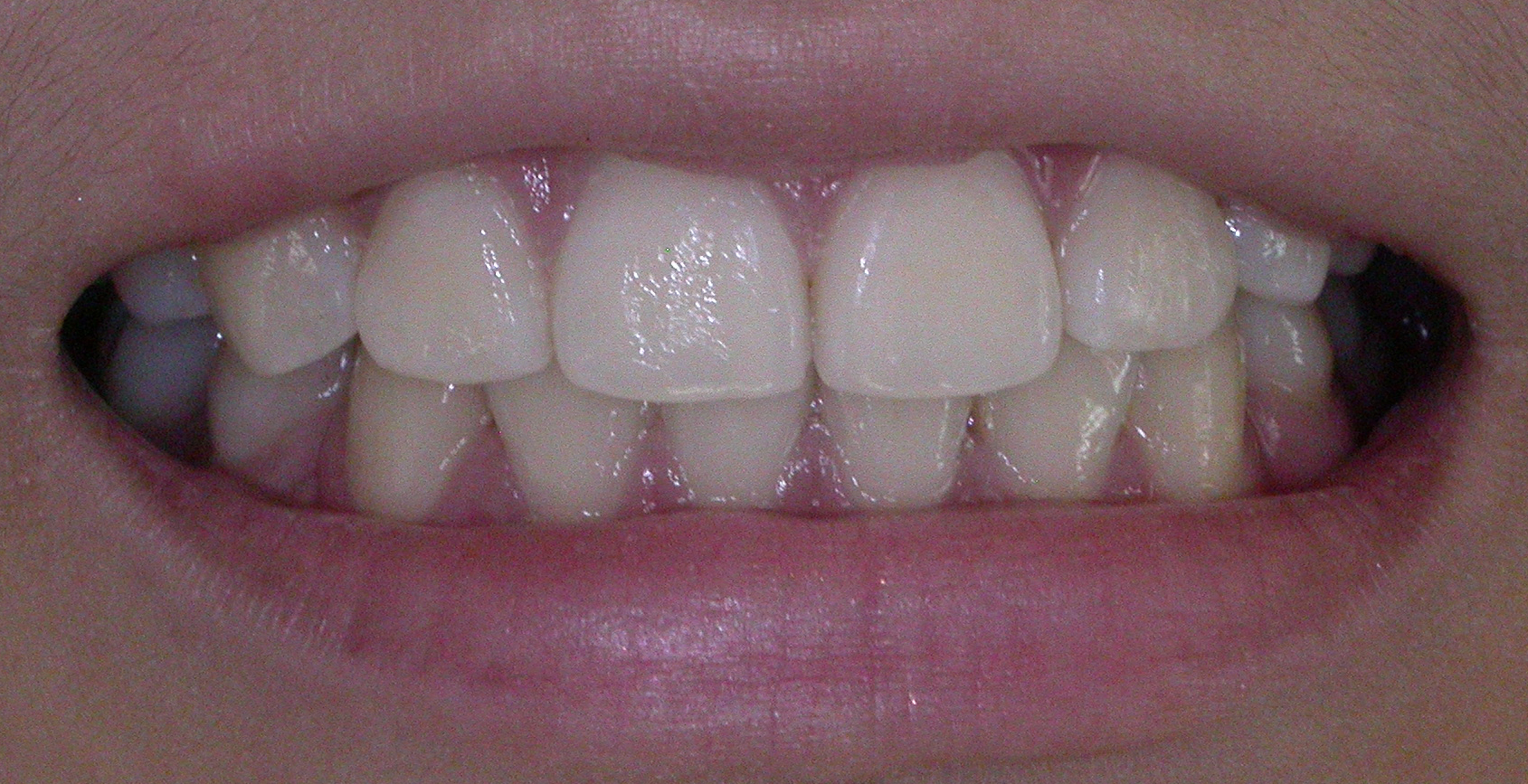 AFTER Invisialign treatment