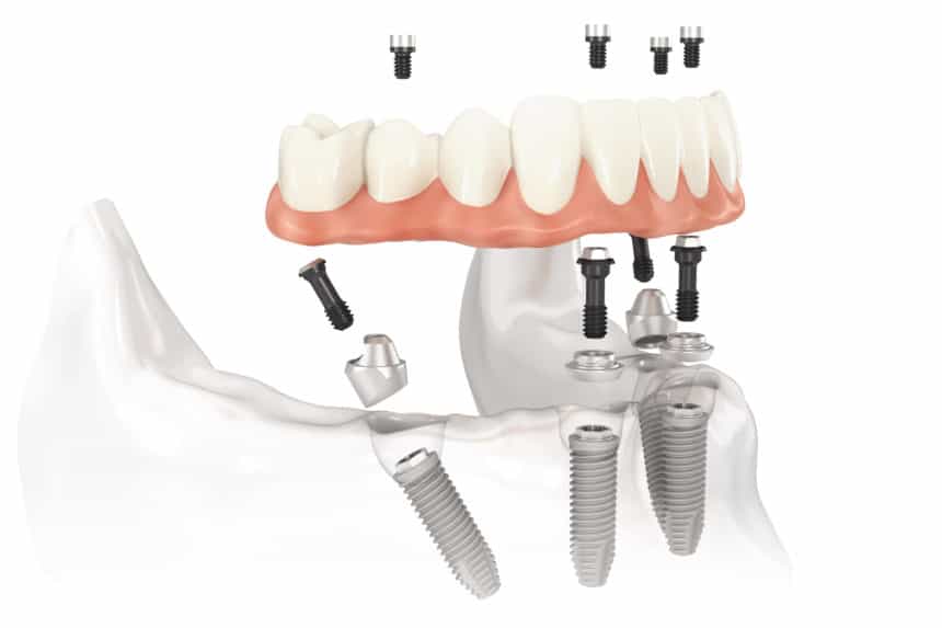 Dental Implants Auckland