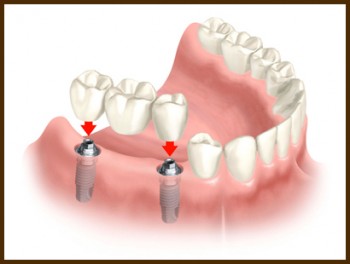 dental-implants-auckland-2 Dental Implants Auckland