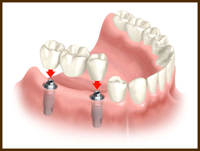 Dental Implants Auckland Dentists