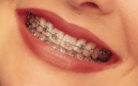 Metal Braces vs. Invisalign