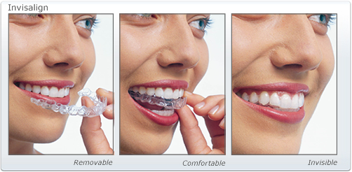 Invisalign Auckland