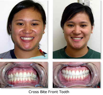 invisalign-before-after-image