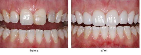 Composite Veneers