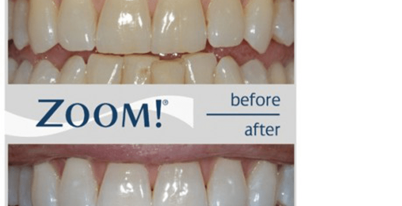 FREE 1 hour ZOOM Teeth-Whitening (valued at $800)!!