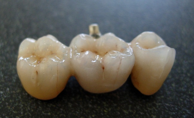 Bridge_from_dental_porcelain