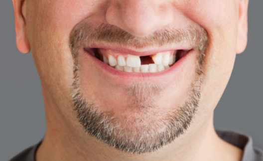 Dental Implants Auckland Dentists