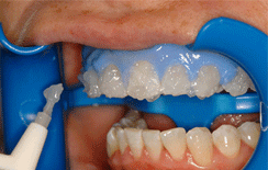 Zoom Teeth Whitening Auckland Dentists