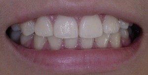 AFTER Invisalign Teeth Straightening Treatment