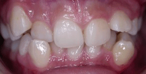 BEFORE Invisalign Teeth Straightening Treatment