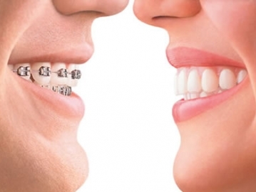 Invisalign Clear Braces