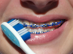 Tips on How to Brush Your Teeth with Braces