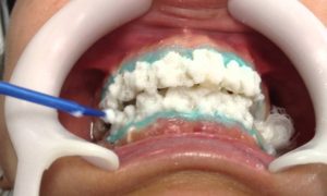 Teeth Whitening Activation