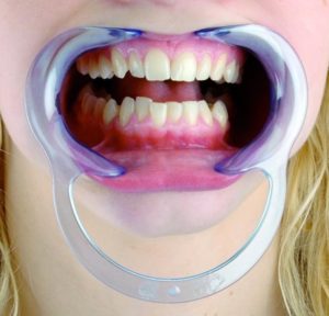 Teeth Whitening Mouth Setting