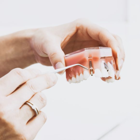 Dental Implants: What to Expect During and After
