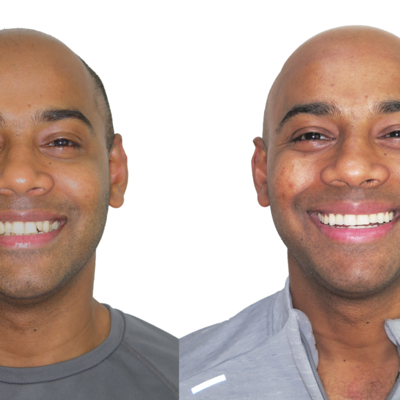 BEFORE & AFTER INVISALIGN