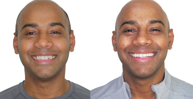 BEFORE & AFTER INVISALIGN